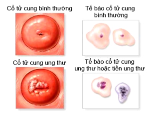 ung thu co tu cung2